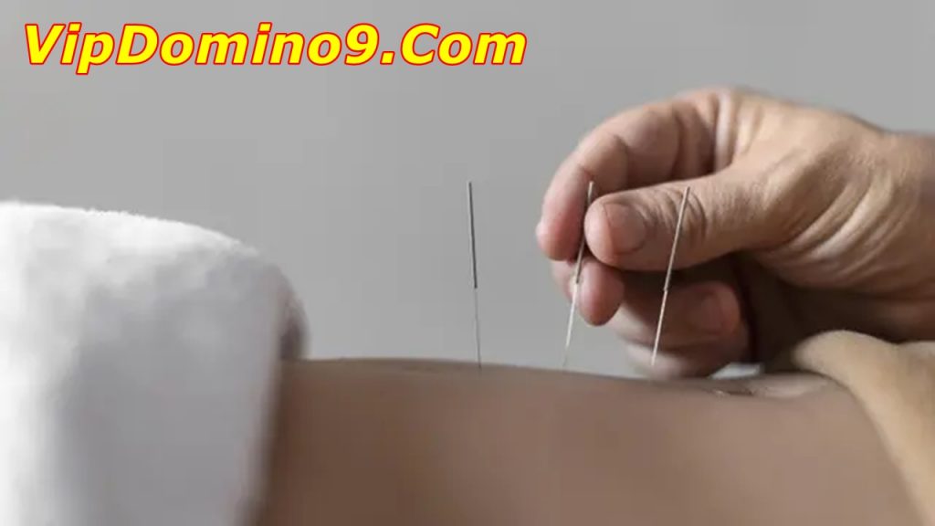 Manfaat Akupuntur untuk Kesehatan